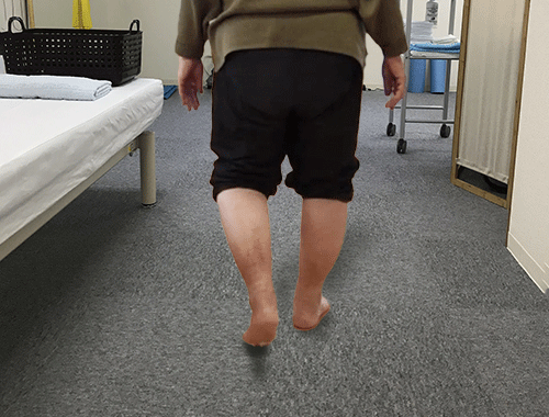 変形性膝関節症のO脚の人の歩行