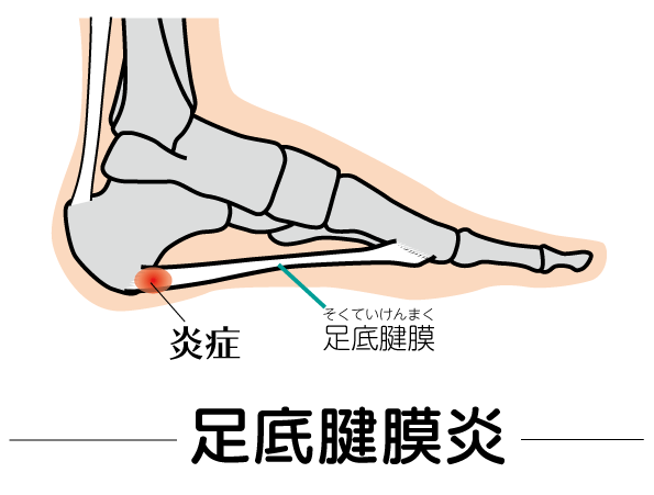 足の裏にある足底腱膜の炎症を足底腱膜炎と言い、多くは踵に近いところが痛みます