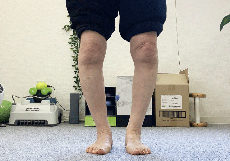 変形性膝関節症の年配女性の脚。O脚になっている。