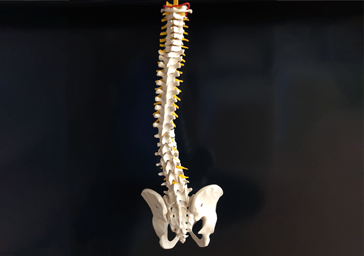 脊柱から骨盤までの骨模型。腰椎が右回旋・右側屈し側弯している